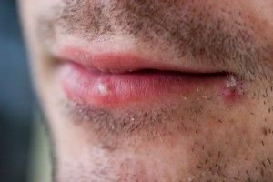 Soap-and-Water Cleanser Can Reduce Skin Infections in Wrestlers