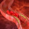How to Lower Triglycerides Naturally