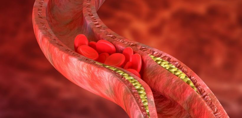 How to Lower Triglycerides Naturally