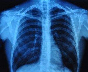 what is chronic obstructive pulmonary disease?